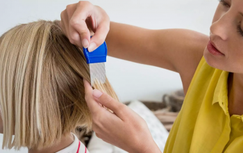 Options for best head lice treatment